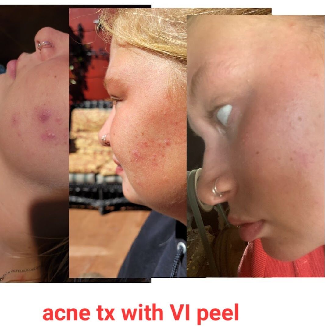 Before and after vitality institute chemical treatment from Natural Esthetics