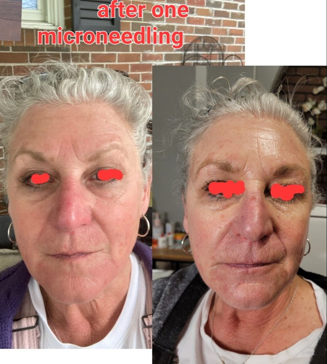 Before and after photo of microneedling from Natural Esthetics