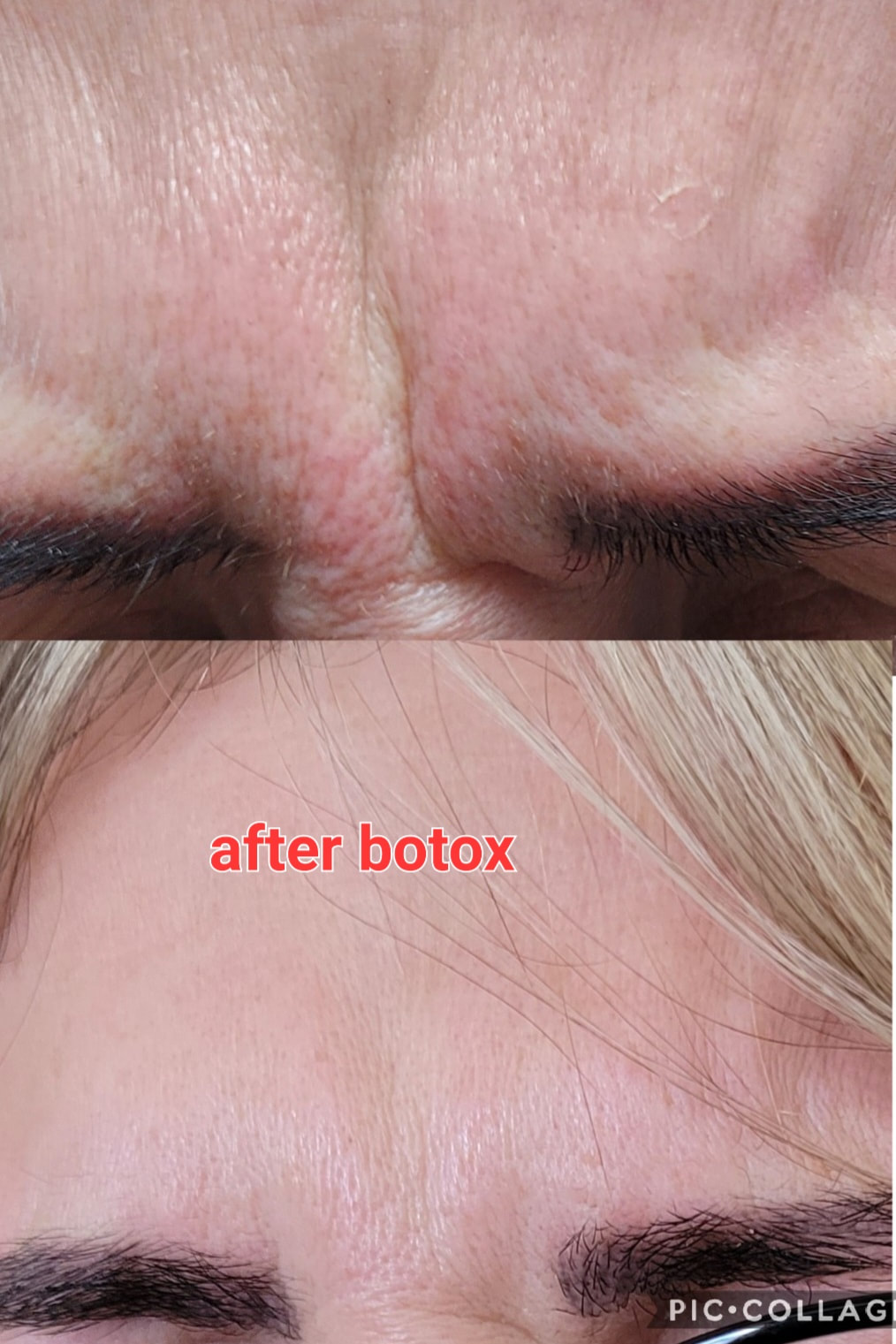 Before and After Botox Treatment at Natural Esthetics in Urbana Ohio
